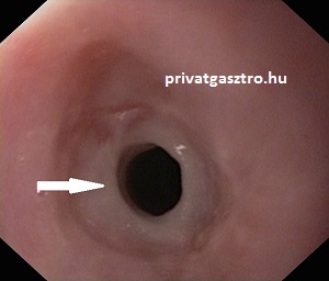nyelőcsőrák gyomortükrözés
