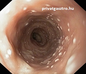 Candida oesophagitis gyommortükrözés