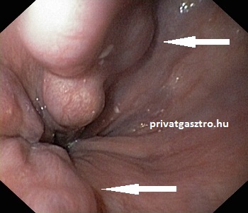 nyelőcső visszér gyomortükrözés
