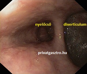 nyelőcső divertikulum gyomortükrözés