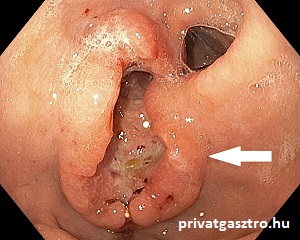 gyomor carcinoma gyomortükrözés