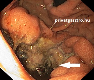 gyomor lymphoma gyomortükrözés