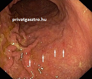 kis carcinoid tumorok gyomortükrözés