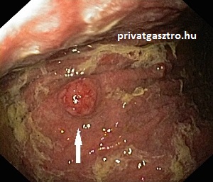 nagy gyomor carcinoid gyomortükrözés