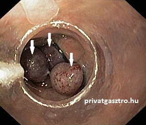 oesophagus varix ligatio gyomortükrözés